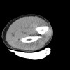 SPORK, NICO - 22.03.1976 - 02.08.2022 - CT obere Extremität - 17:56:57
